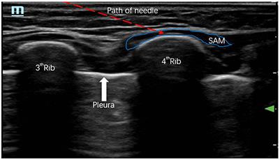 Case report: Ultrasound-guided bilateral serratus anterior plane block in intensive care unit—An alternative to opioid-sparing postoperative analgesia after sternotomy in infants